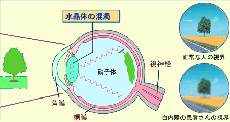 白内障のメカニズム